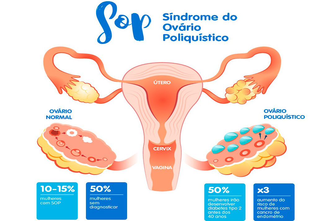 Ooforite ou ovarite: causas, sintomas, diagnóstico e tratamento - Saúde da  Mulher > AbcMed